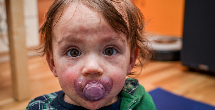 a_small_child_with_a_rash_on_their_face_sucking_a_dummy