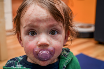 a_small_child_with_a_rash_on_their_face_sucking_a_dummy